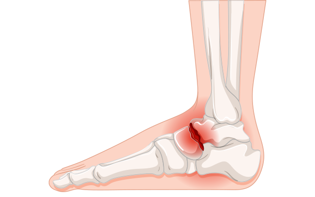 Illustration of an ankle fracture region highlighted